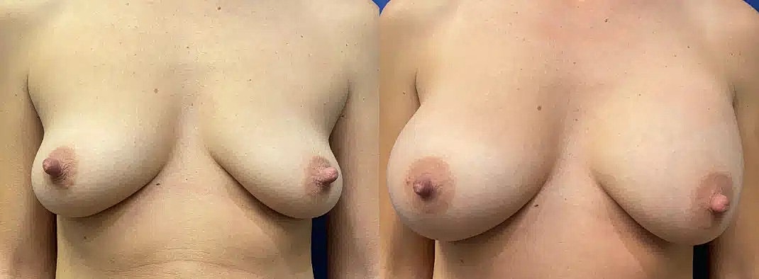 Aumento De Senos Before & After