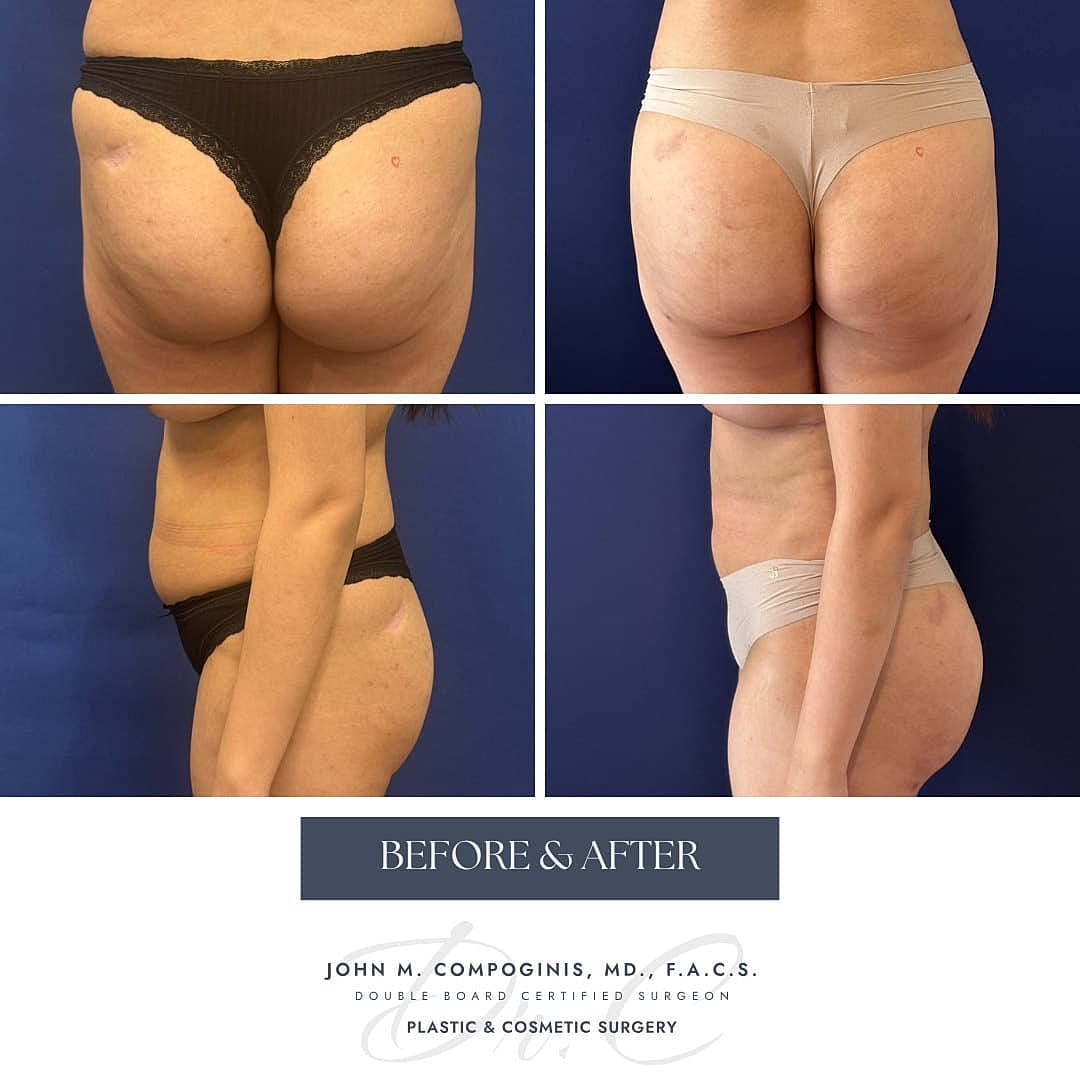 Brazilian Butt Lift Before & After