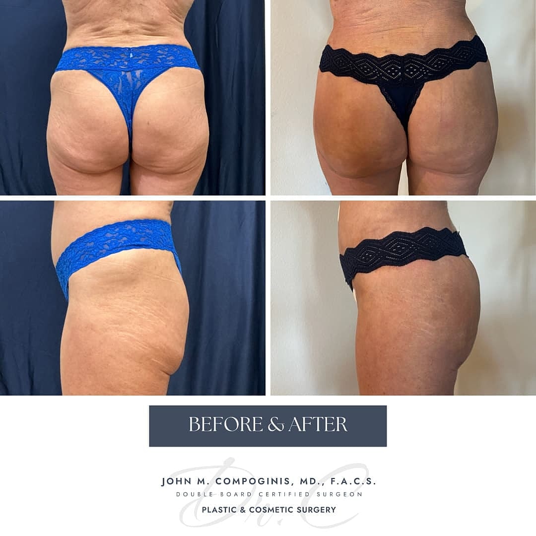 Brazilian Butt Lift Before & After