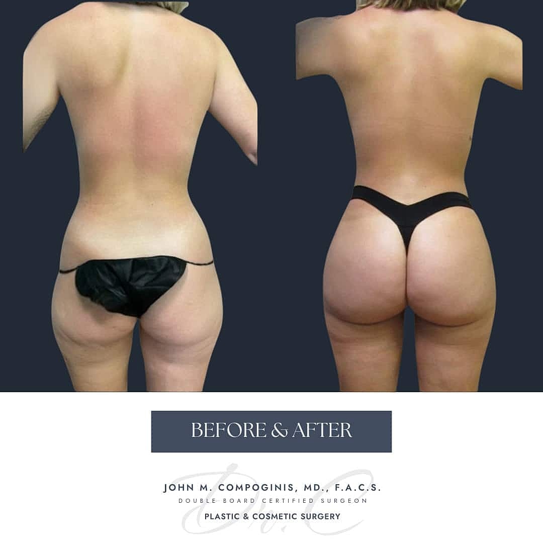 Brazilian Butt Lift Before & After