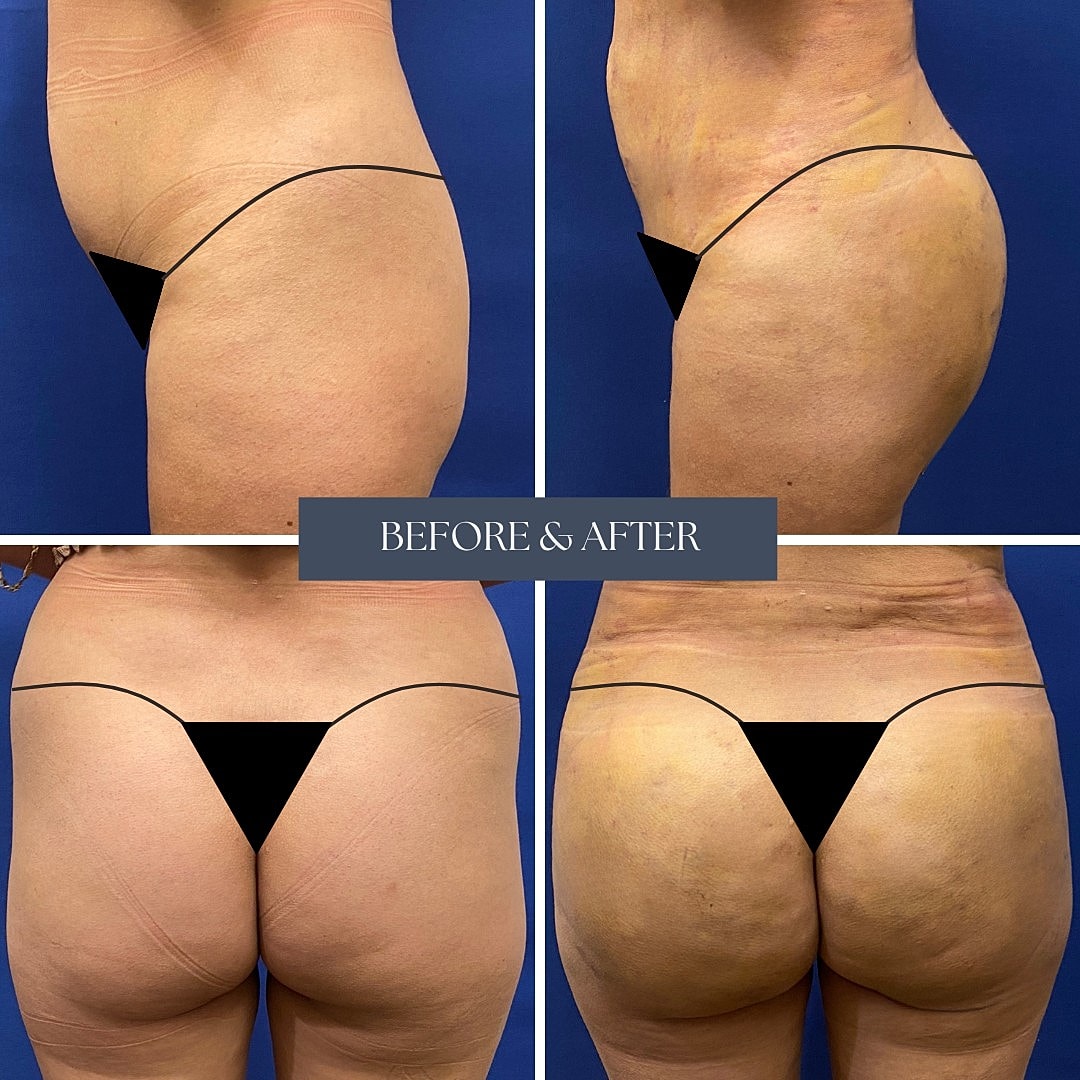 Body transformation before and after procedure.