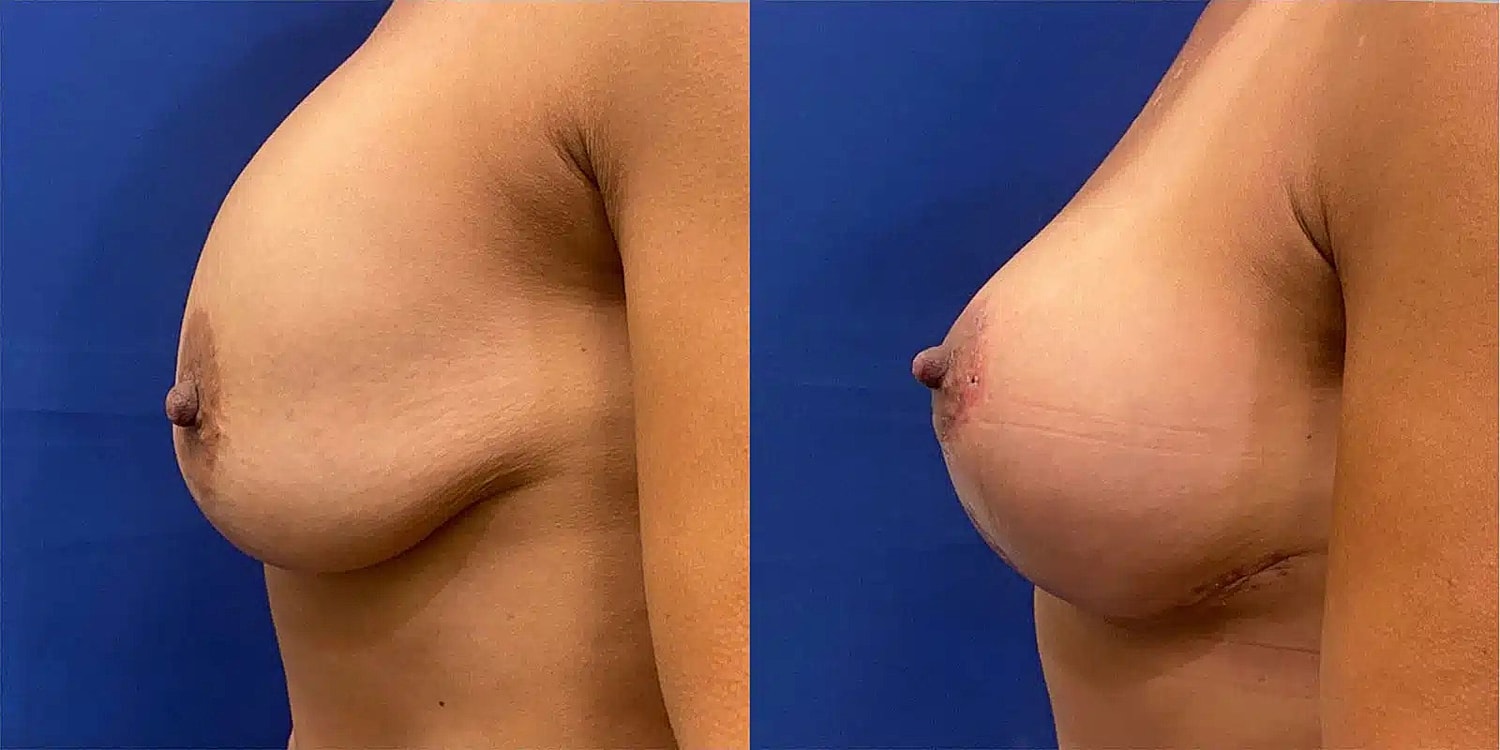 Levantamiento De Senos Before & After