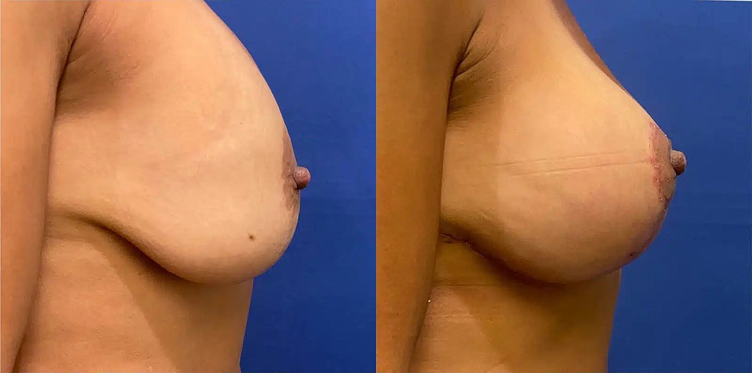 Levantamiento De Senos Before & After