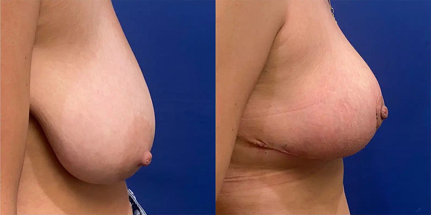 Levantamiento De Senos Before & After