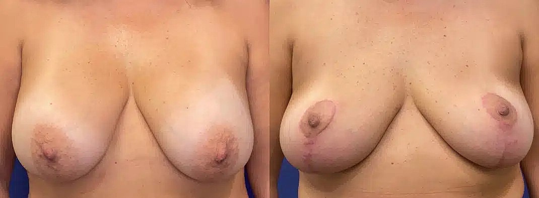 Levantamiento De Senos Before & After