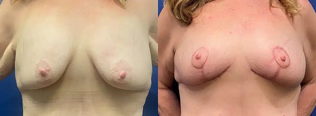 Levantamiento De Senos Before & After