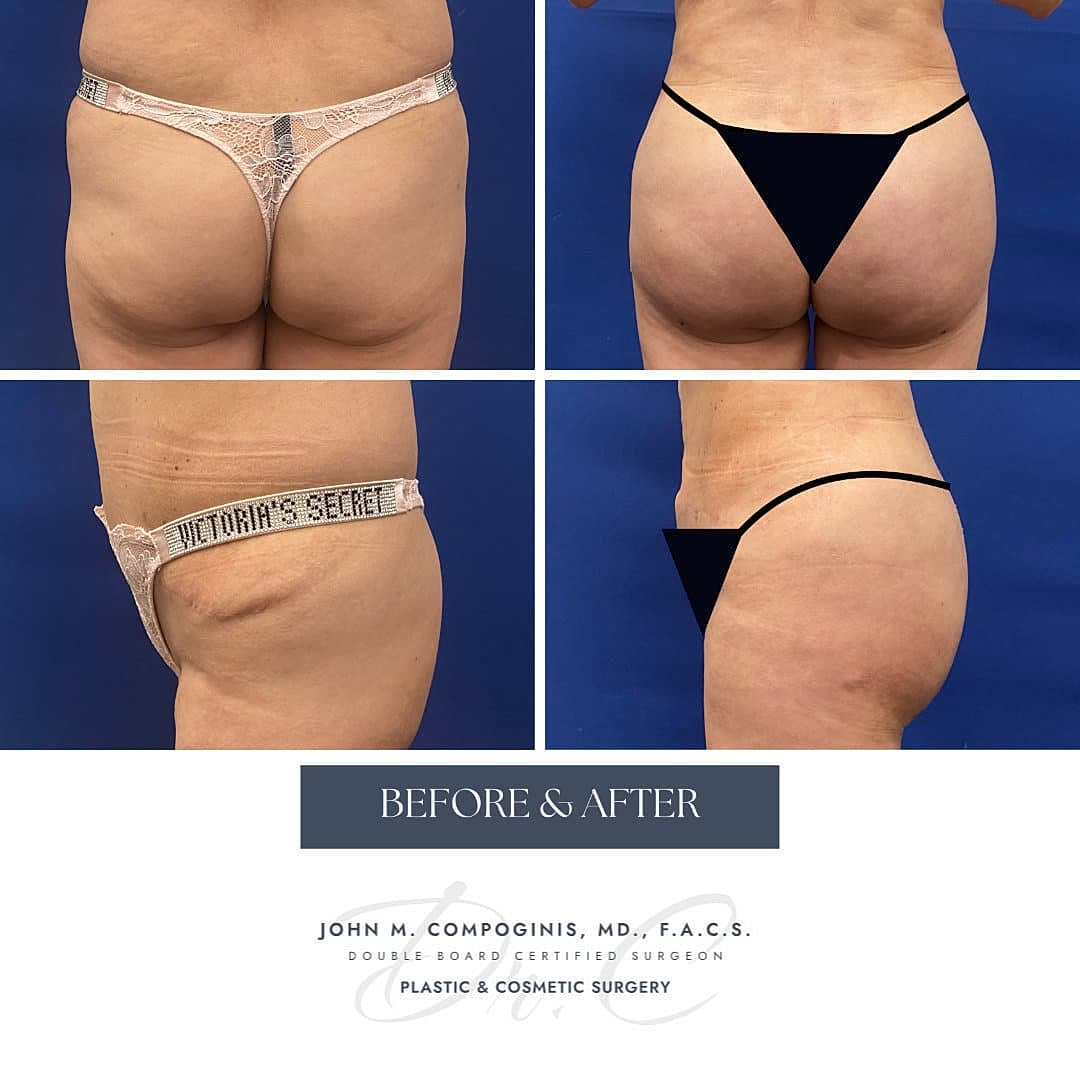 BBL Brasileno Before & After