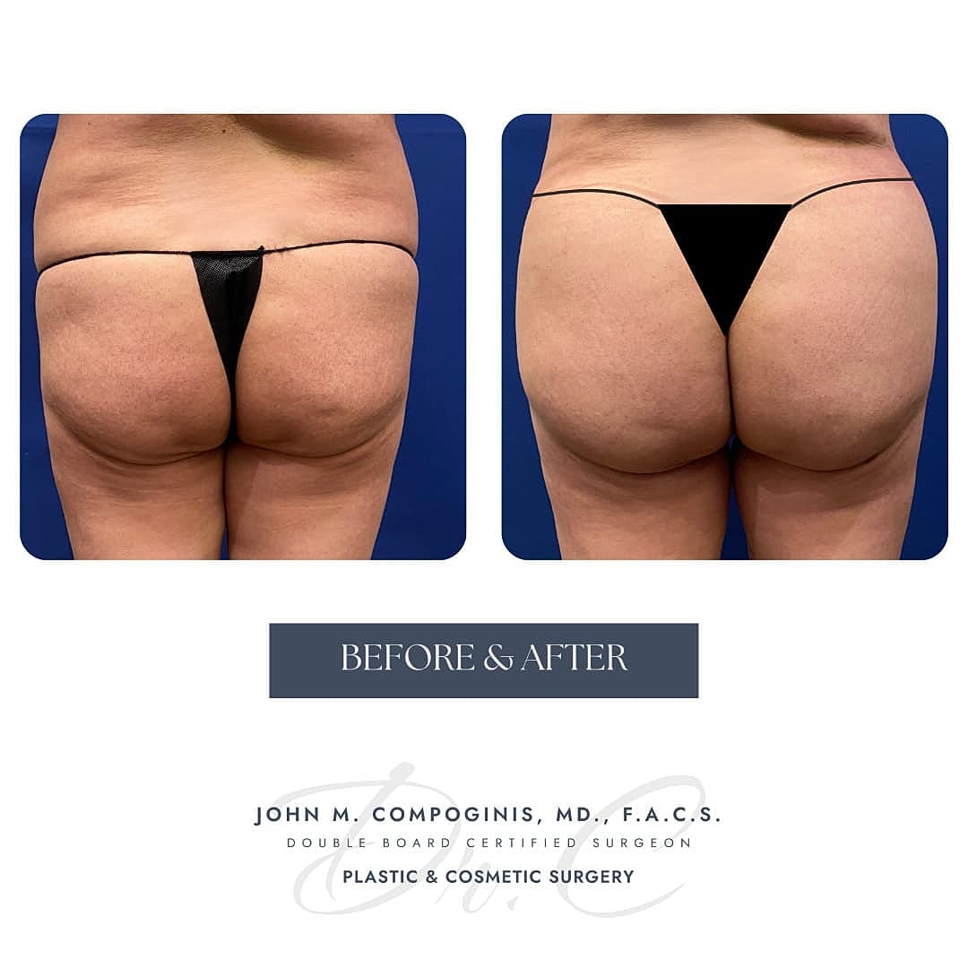 BBL Brasileno Before & After