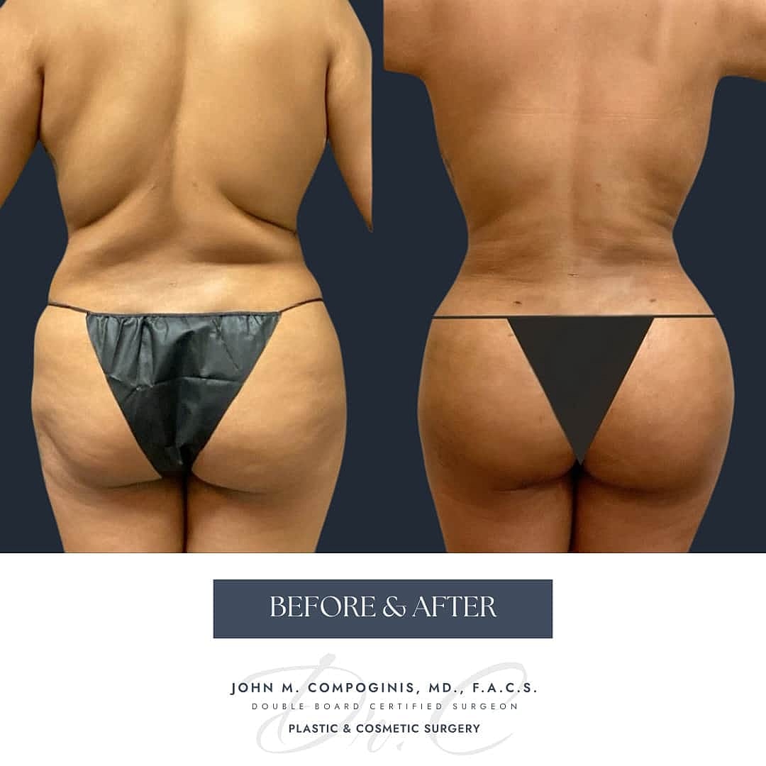 BBL Brasileno Before & After