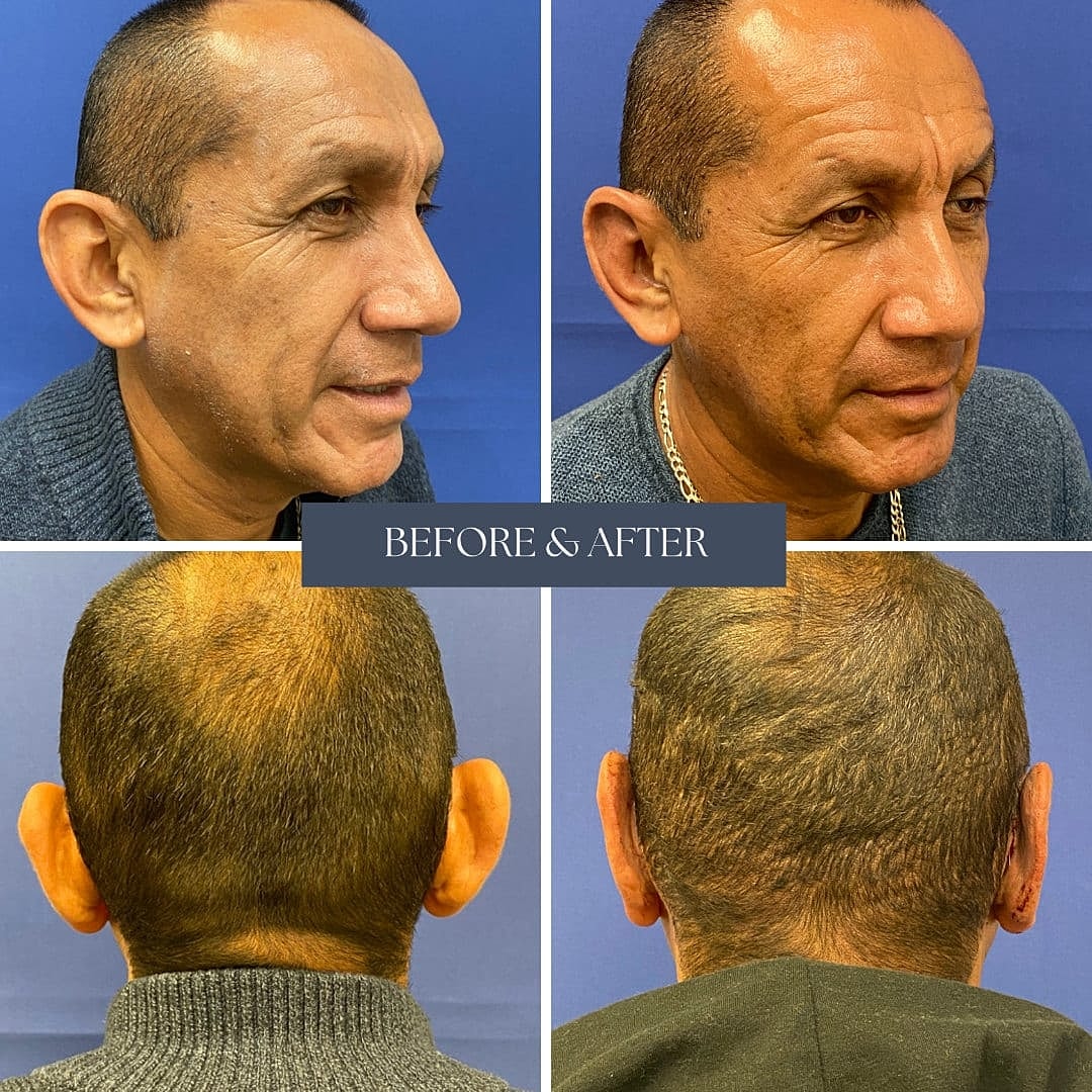 Ear Procedures Before & After