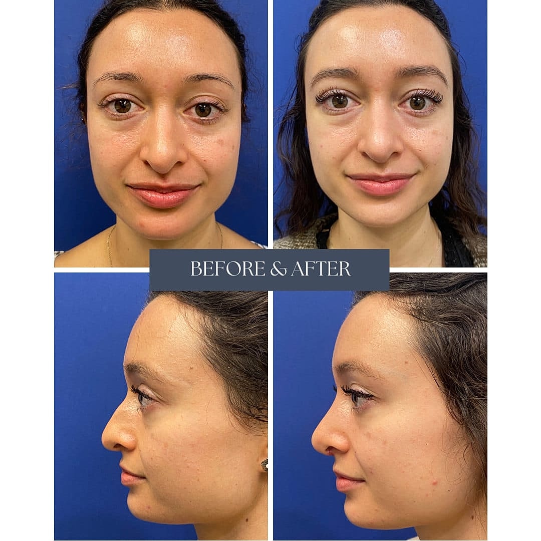 Rinoplastia Before & After