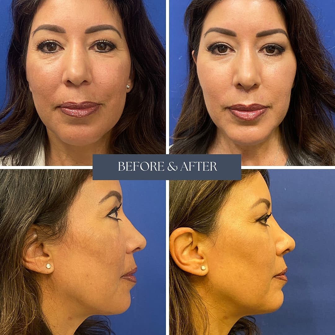 Rinoplastia Before & After