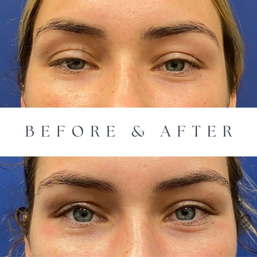 Blefaroplastia Before & After