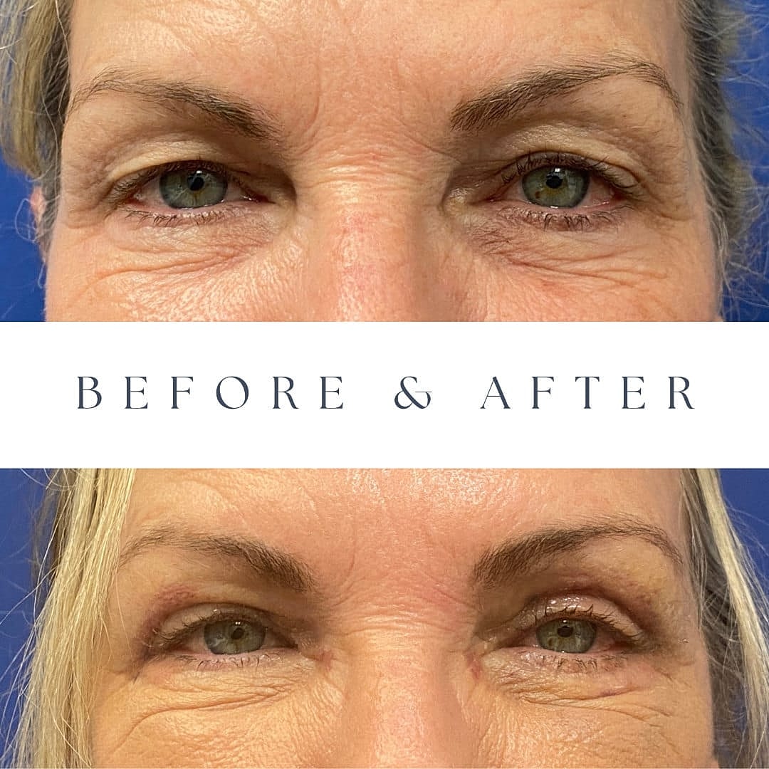Blefaroplastia Before & After