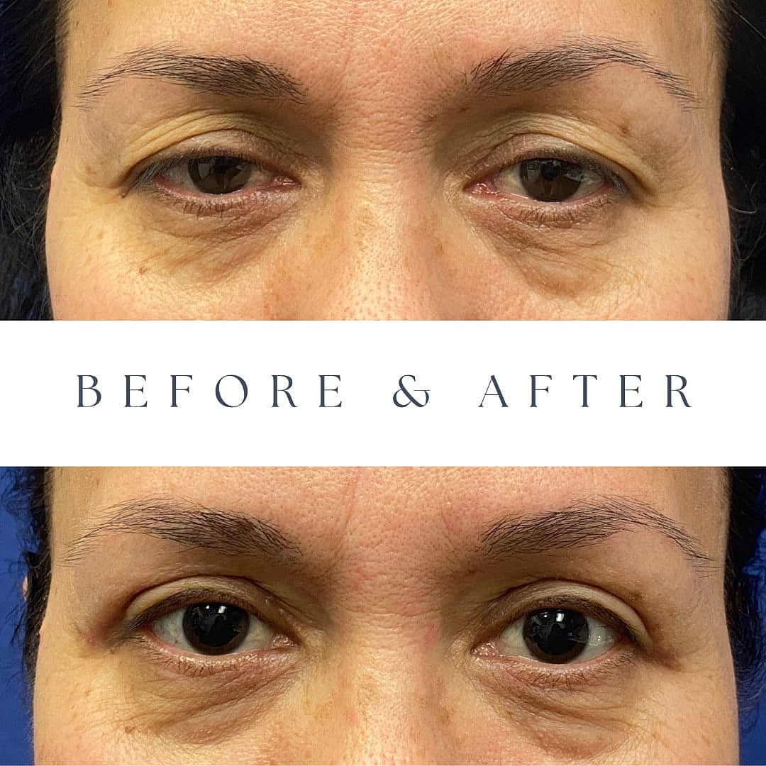 Blefaroplastia Before & After