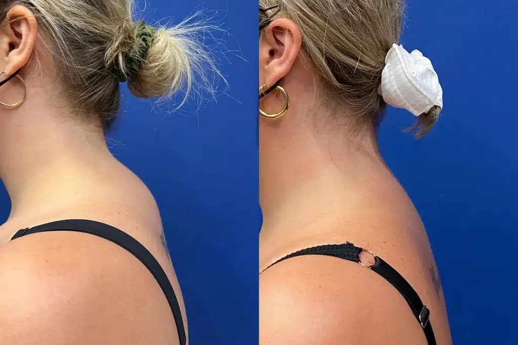 liposuction before and after photo by john m compoginis md facs in newport beach ca