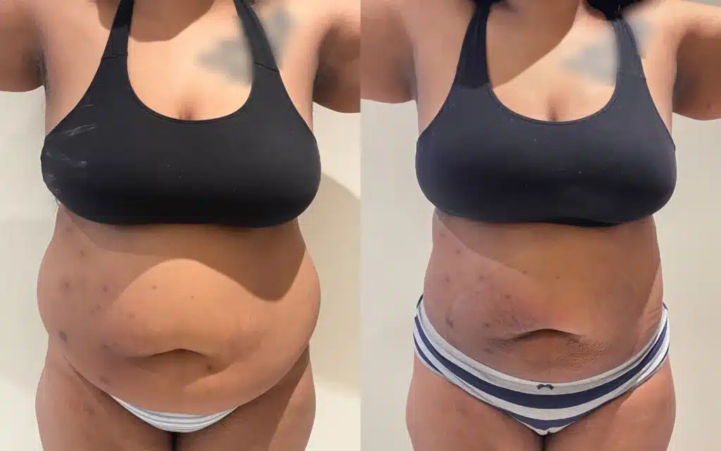 liposuction before and after photo by john m compoginis md facs in newport beach ca