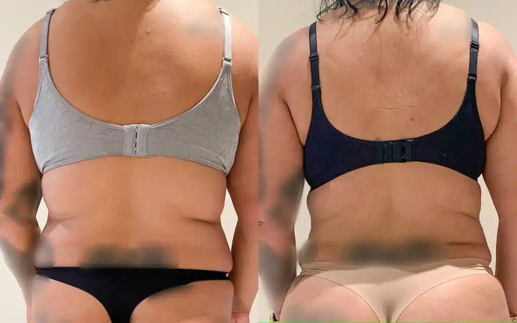 liposuction before and after photo by john m compoginis md facs in newport beach ca