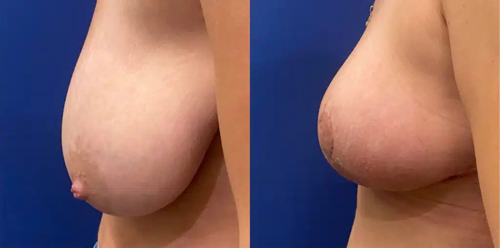 breast lift before and after photo by john m compoginis md facs in newport beach ca
