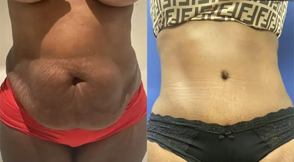 tummy tuck before and after photo by john m compoginis md facs in newport beach ca