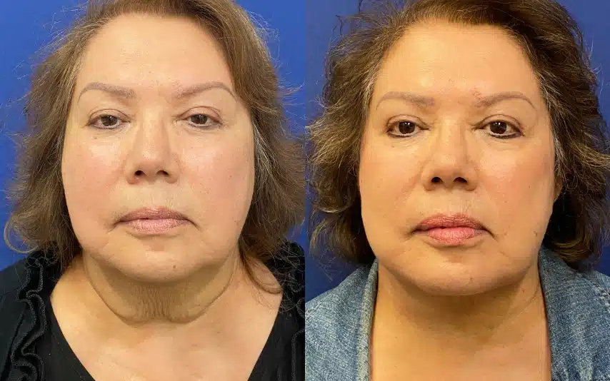 facelift before and after photo by john m compoginis md facs in newport beach ca