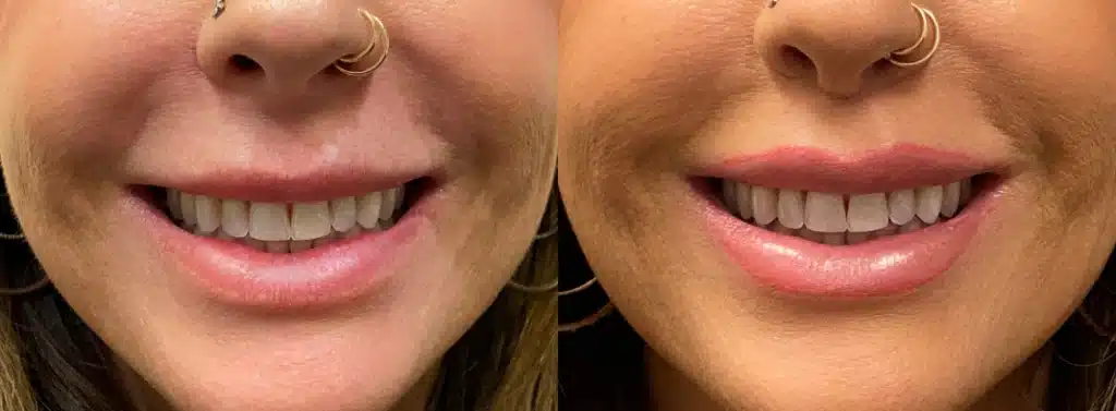 lip enhancement before and after photo by john m compoginis md facs in newport beach ca