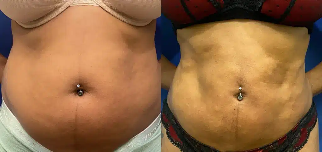 liposuction before and after photo by john m compoginis md facs in newport beach ca