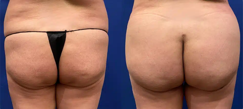 brazilian butt lift before and after photo by john m compoginis md facs in newport beach ca