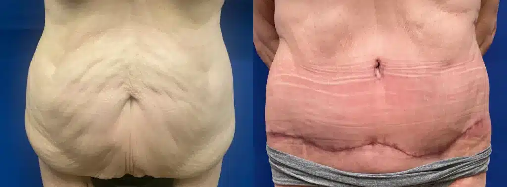 tummy tuck before and after photo by john m compoginis md facs in newport beach ca