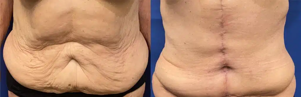 tummy tuck before and after photo by john m compoginis md facs in newport beach ca